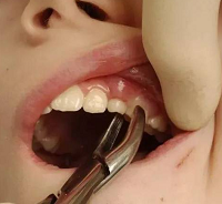 普通拔牙、阻生齒、牙周基礎(chǔ)*（刮治）