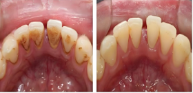 齦上/下潔治（洗牙）、齲齒充填（補(bǔ)牙）