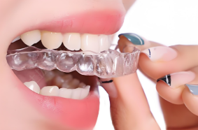 隱形矯正（隱適美、正雅、時(shí)代天使）