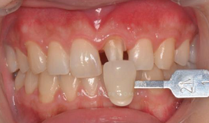 全瓷冠、美學(xué)樹脂修復(fù)