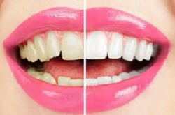 皓齒美白套裝、瓷貼面/超薄貼面