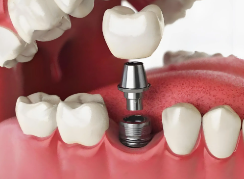 單顆/多顆種植牙、即刻種植