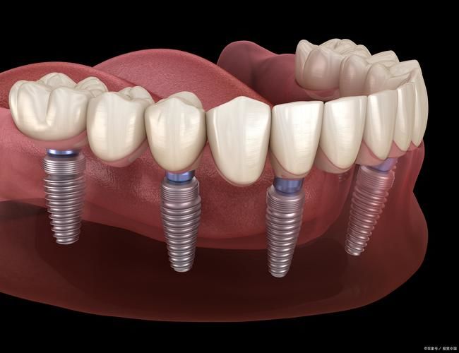 全口/半口種植（All-on-4/6）