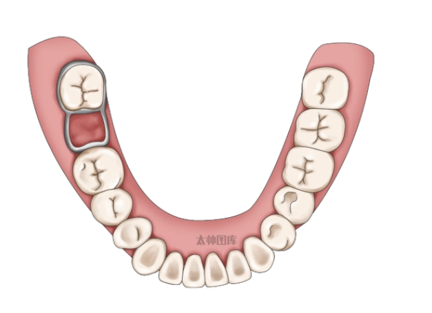 咬合誘導(dǎo)矯正、間隙保持器