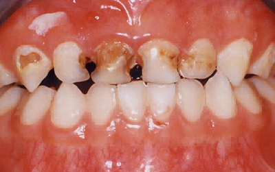 乳牙齲齒防治（乳牙根管*、預(yù)成冠）