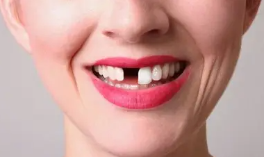 牙齒缺失，應(yīng)該選種植牙還是選烤瓷牙