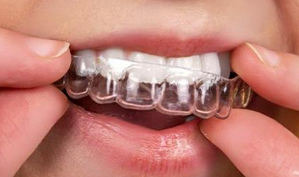 成人矯正牙齒保持器要戴多久?