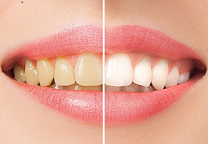 美白套裝美白牙齒需要做幾次?